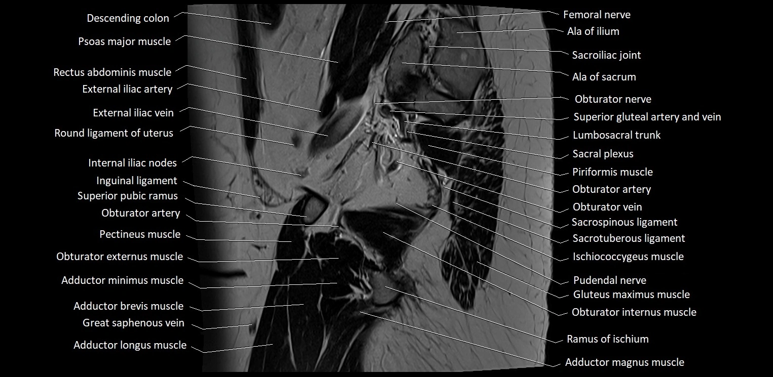 Sagittal cross sectional anatomy of female pelvis (MRI 3T) image 36.webp